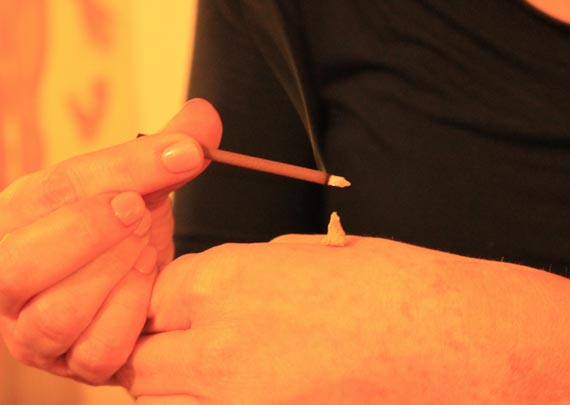 Applicazione di calore con coni o sigari di artemisia ai punti di agopuntura
